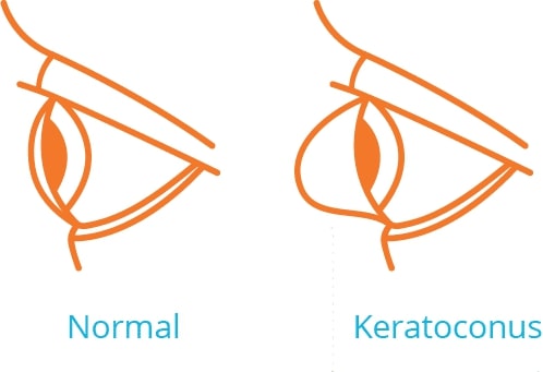 side view illustrations of one normal eye and one eye with keratoconus bulge on cornea