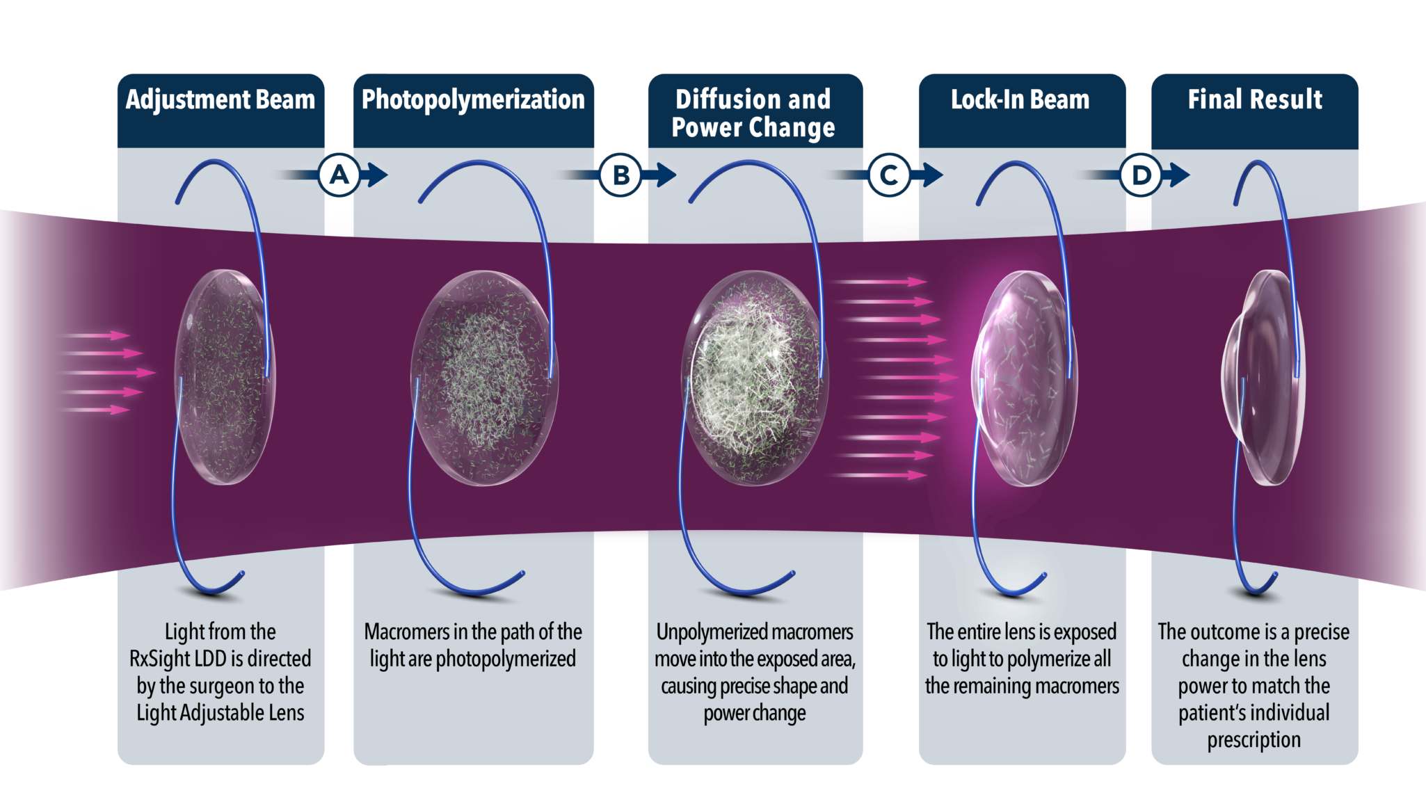 Light Adjustable Lens Process