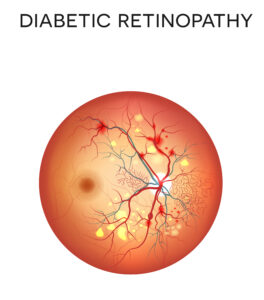 Illustration of eyeball with many red spots showing damage from diabetes