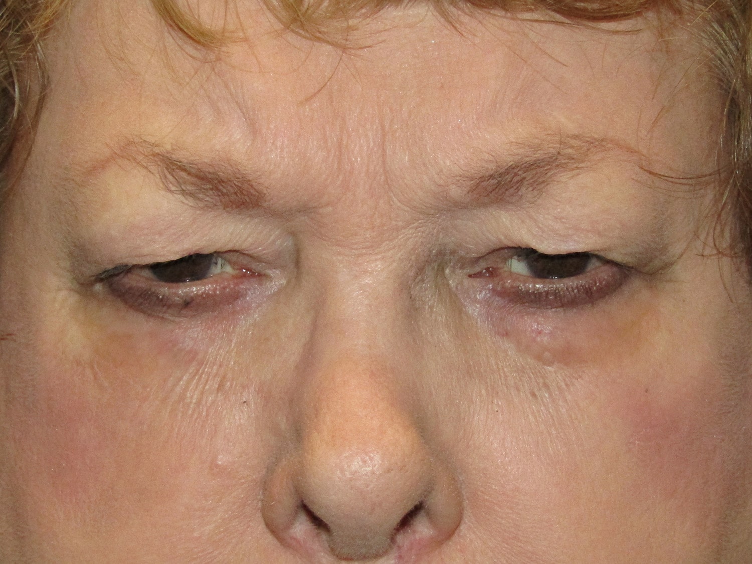 Before Image: Endoscopic Bilateral Upper Lid Blepharoplasty - front