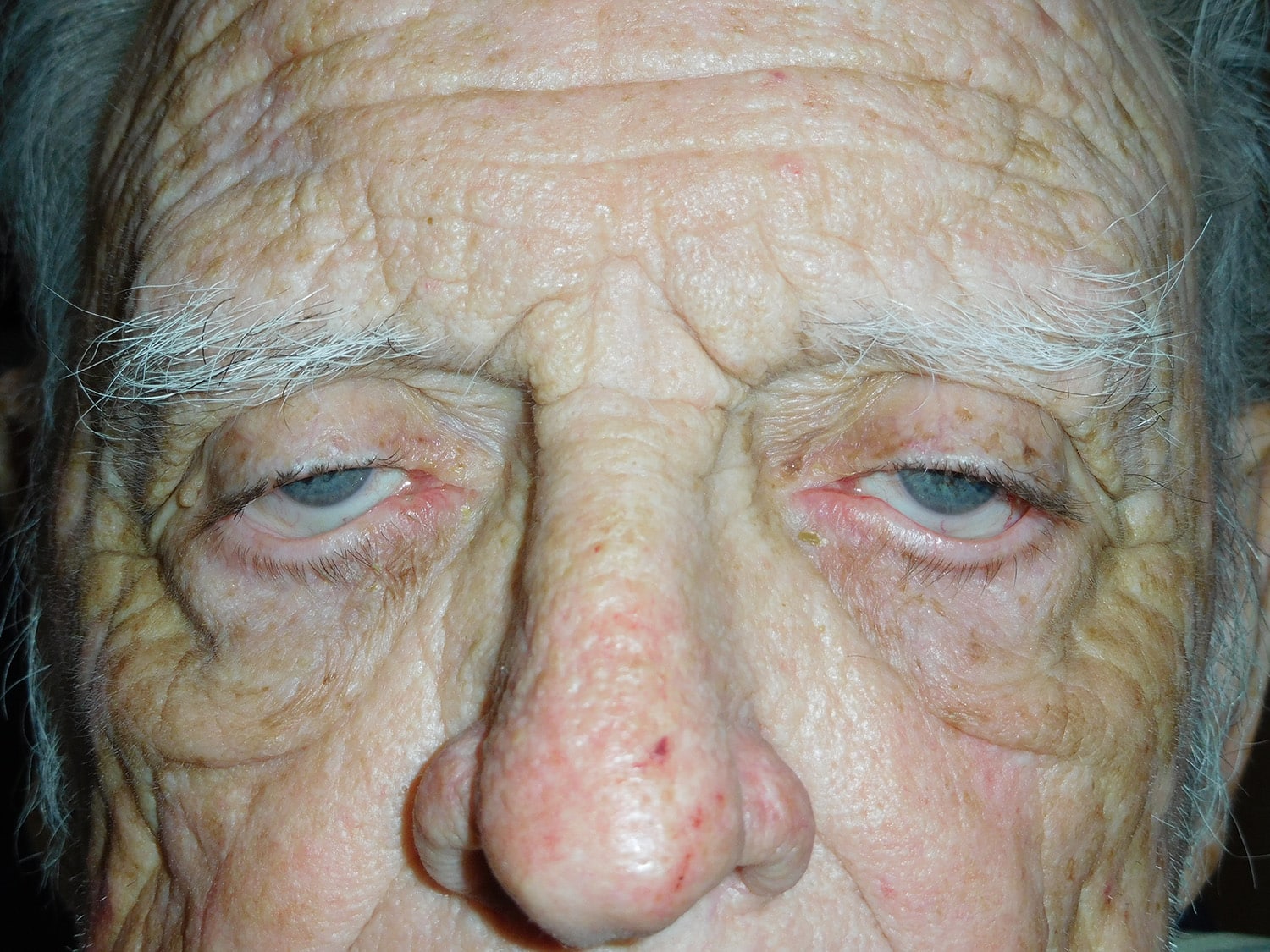 Before Image: Bilateral Ptosis Ectropion Repair - front