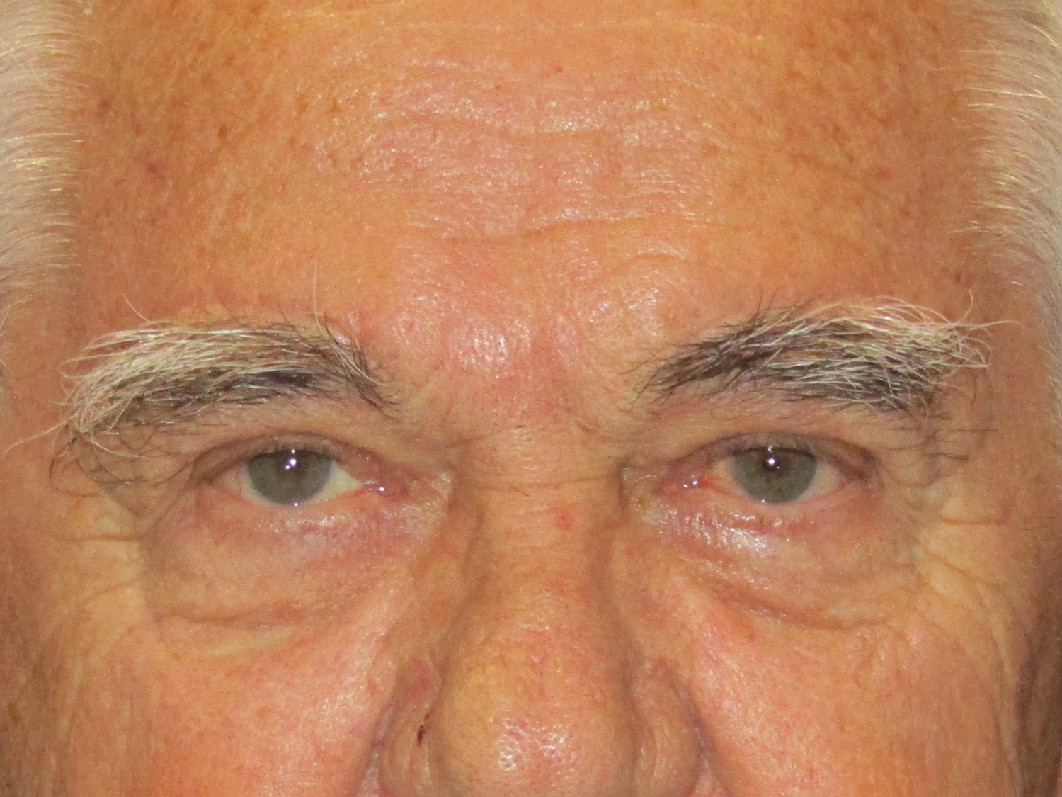 After Image: Bilateral Supraciliary Repair - front