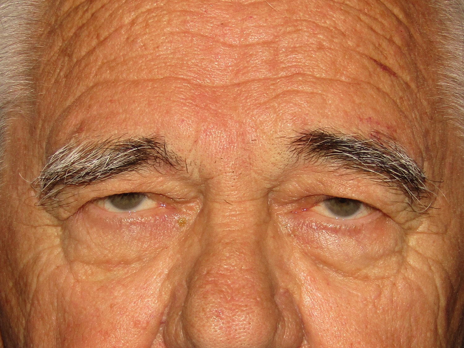 Before Image: Bilateral Supraciliary Repair - front