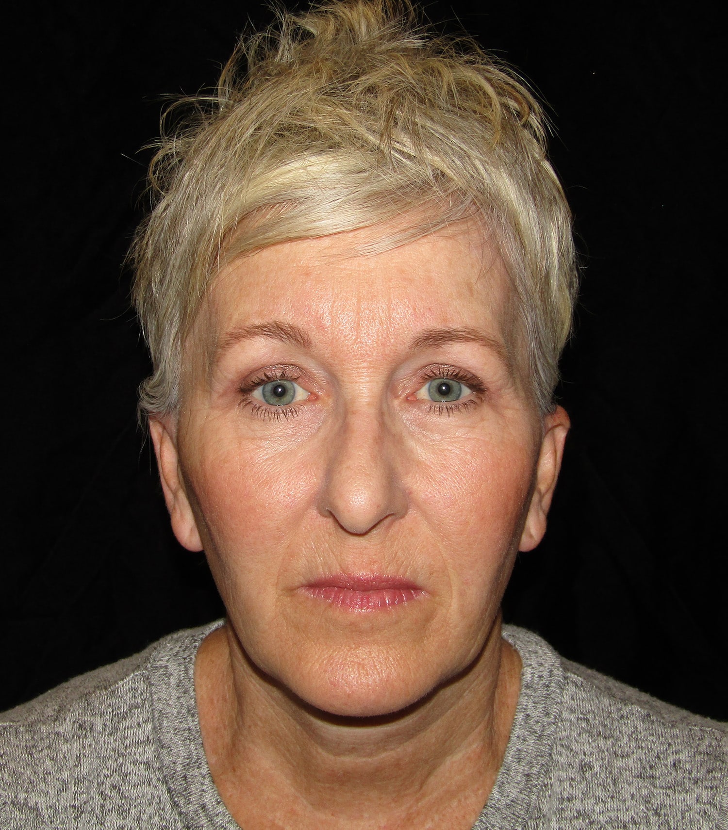 After Image: Lower Facelift & Upper Blephroplasty - front
