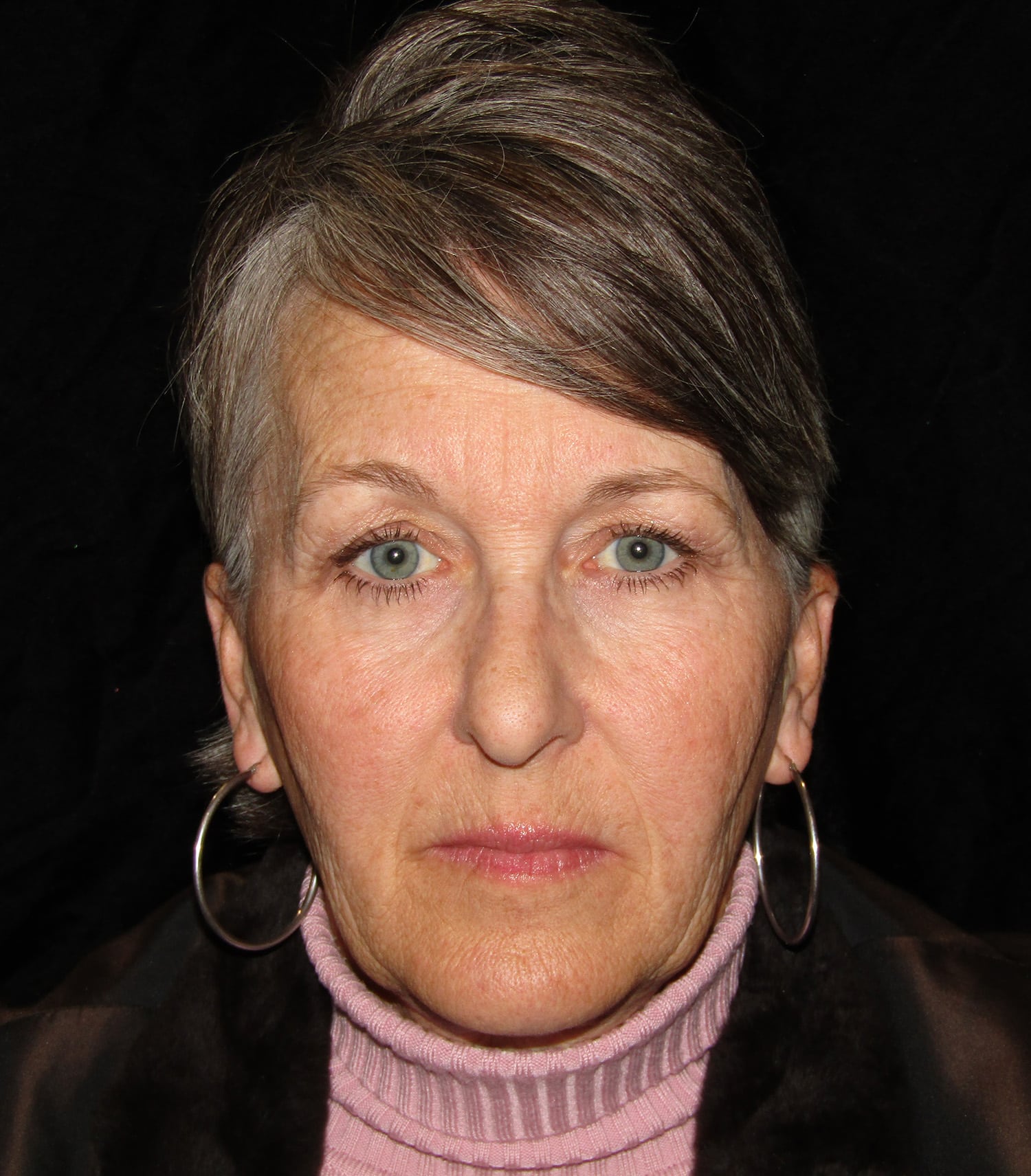 Before Image: Lower Facelift & Upper Blephroplasty - front