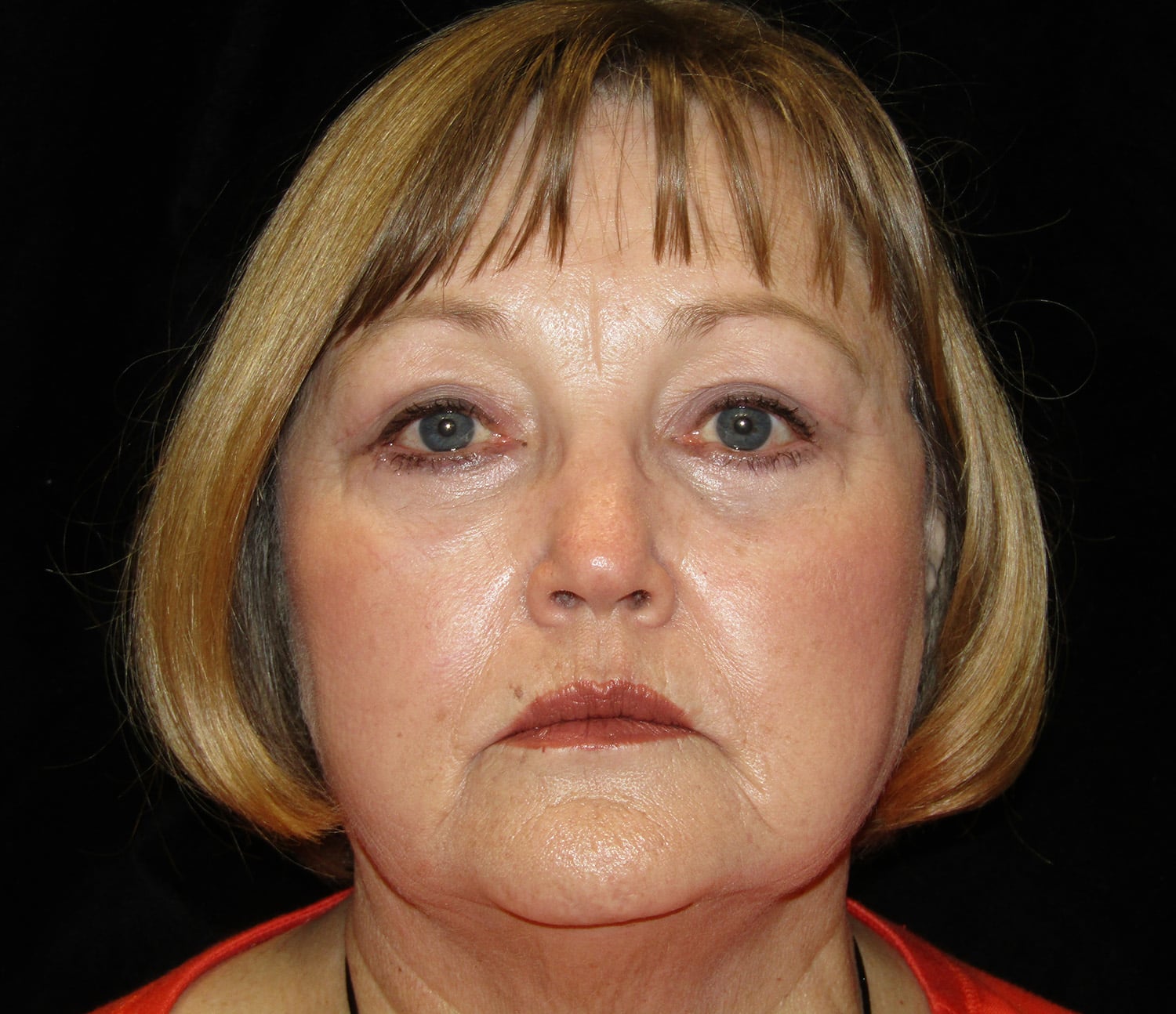 After Image: Quad Blephroplasty Soof Cheek lift - front