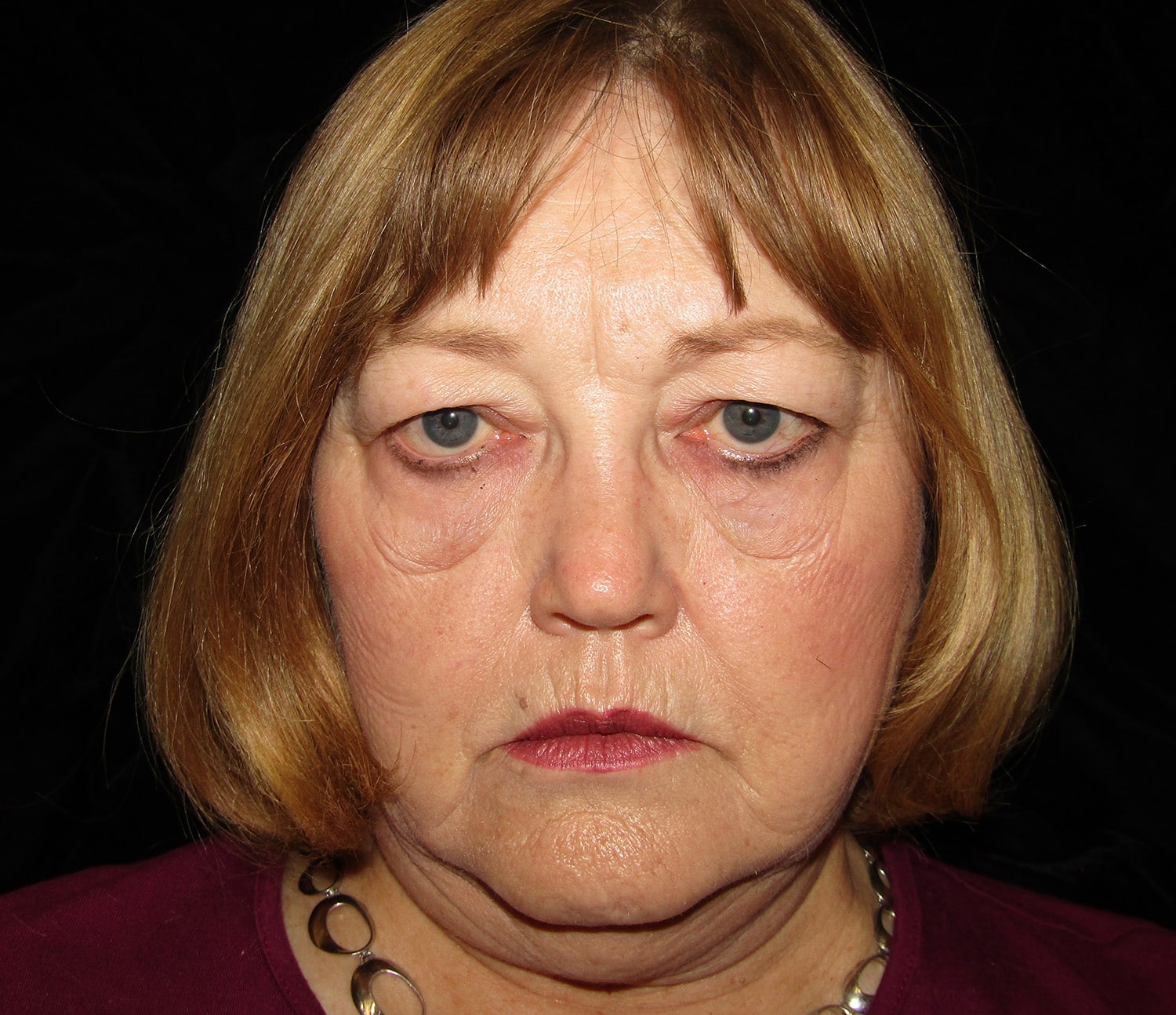 Before Image: Quad Blephroplasty Soof Cheek lift - front