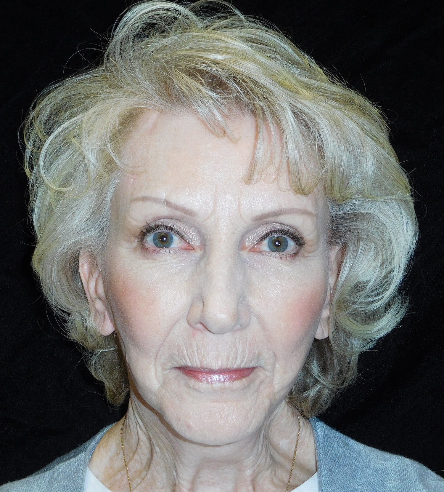 After Image: Endoscopic Facelift & Quad Blephroplasty - front