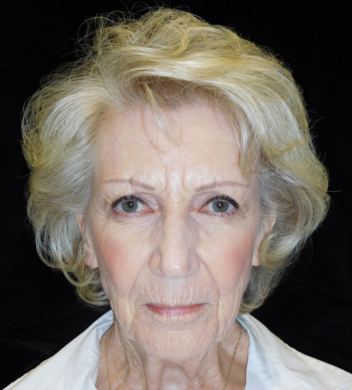 Before Image: Endoscopic Facelift & Quad Blephroplasty - front