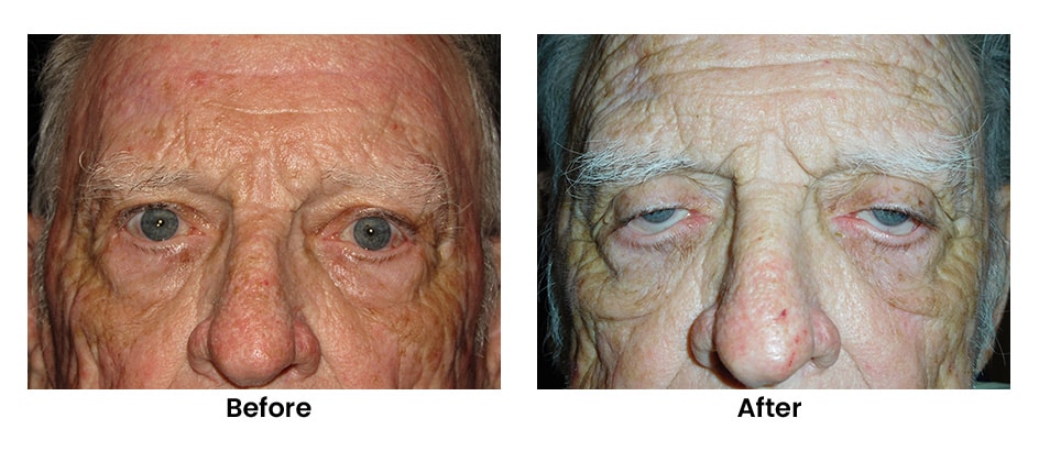 113657 bilateral ptosis ectropion repair feat case 1