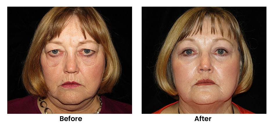113660 quad bleph soof cheek lift feat case