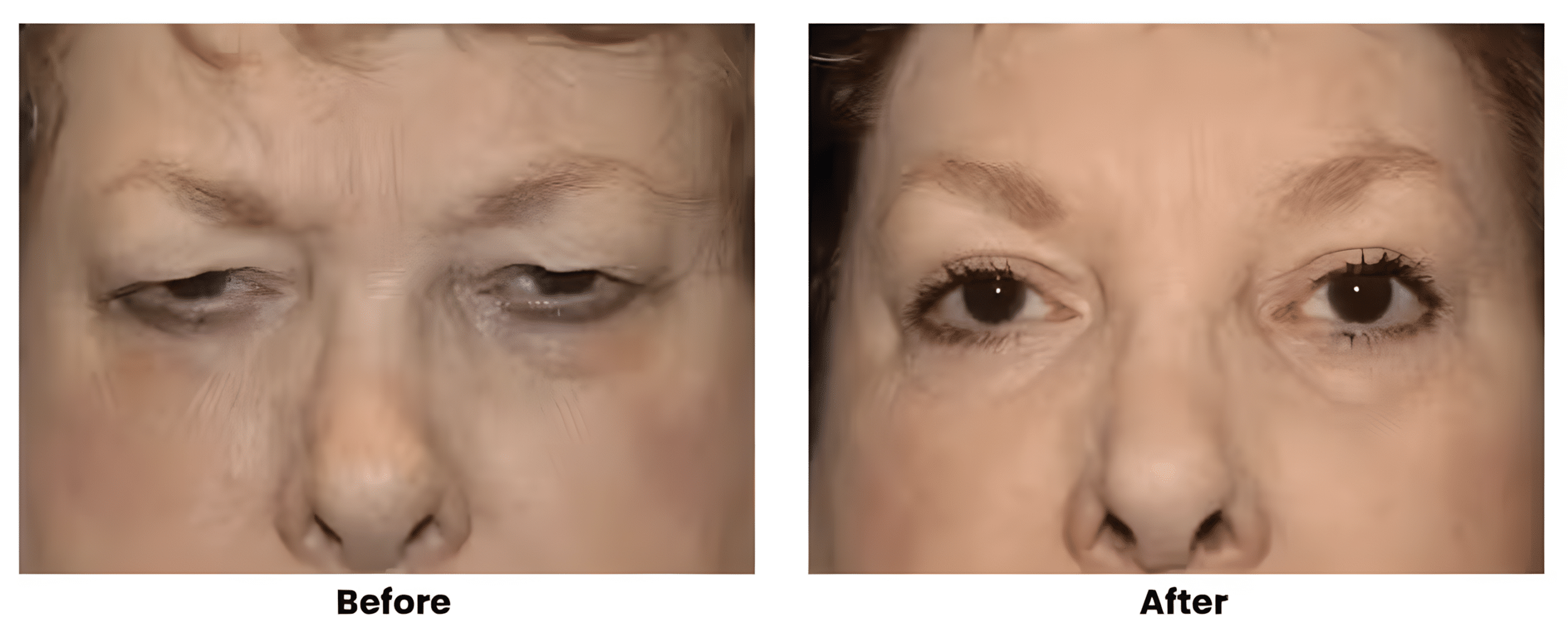 Screenshot 2026-02-12 at 1.39.59 PM_upscayl_2x_upscayl-standard-4x Brow Lift in St. George, UT